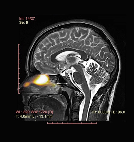 Navigation Item - TRANSCRIBRIAL DRUG DELIVERY